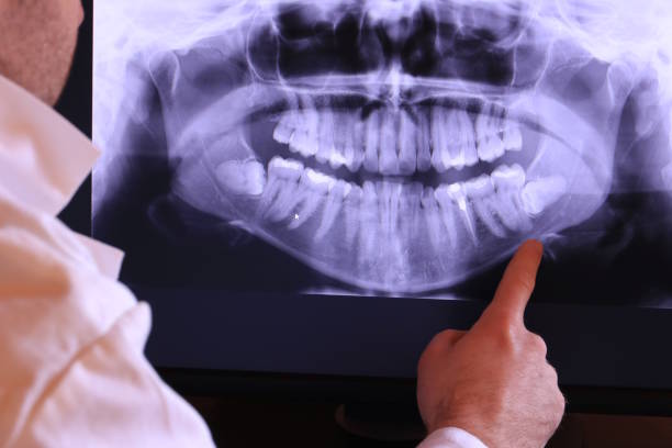 Best Emergency Wisdom Tooth Extraction in La Vista, NE