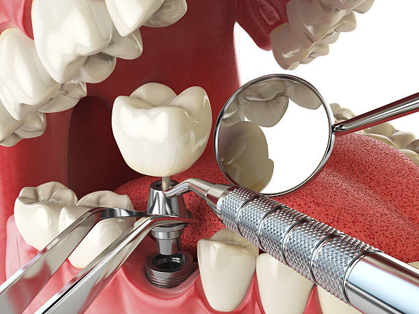 Best Emergency Denture Repair in La Vista, NE
